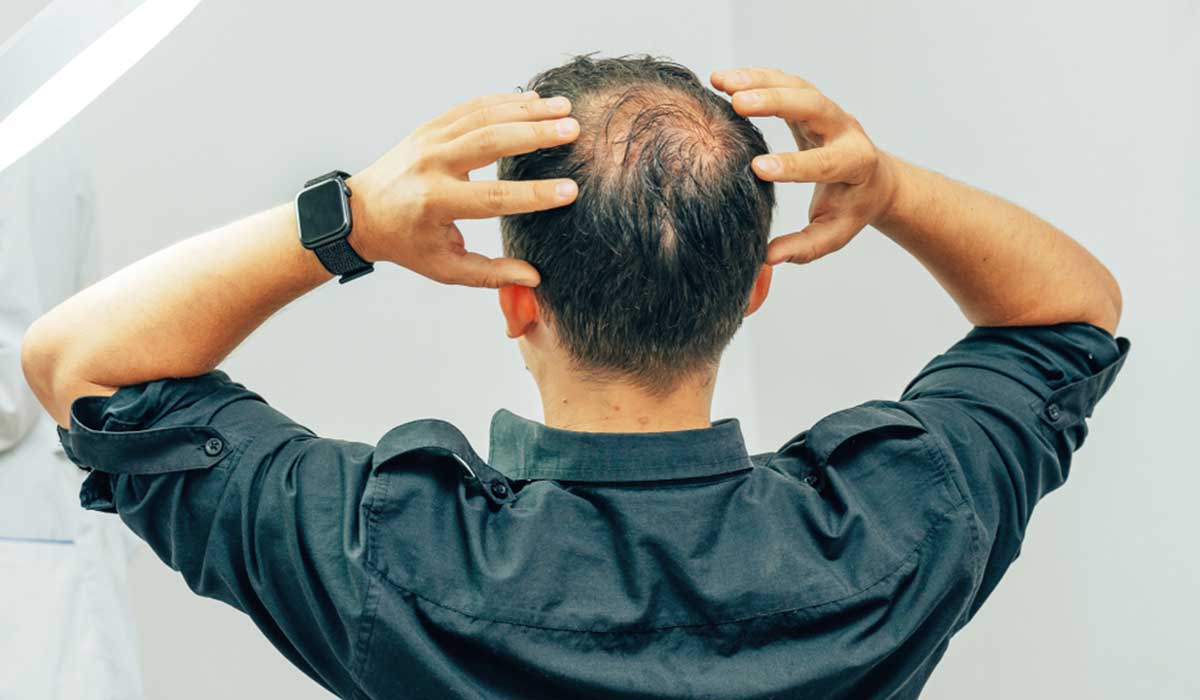 دراسة تكشف أغرب سبب يؤدي إلى الصلع وفقدان الشعر