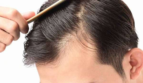 اسباب تساقط الشعر من الامام وكيفية علاج المشكلة