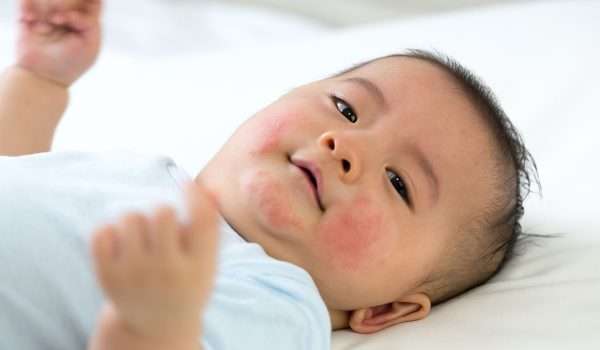 احمرار الجلد عند الاطفال