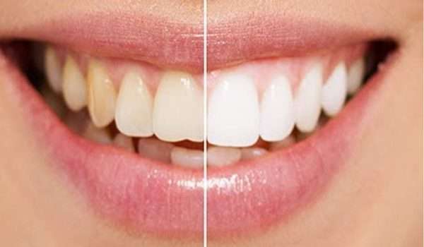 هل إزالة الجير من الأسنان مؤلم؟