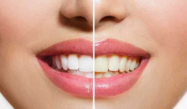 تغيّر لون الأسنان، الأسباب والعلاج
