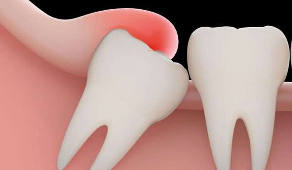 جراحة الأسنان المطمورة