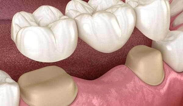 متى تحتاج جسر الأسنان وما هي أنواعه؟