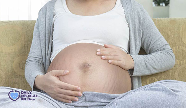 تشققات الحمل (علامات التمدد للحامل)