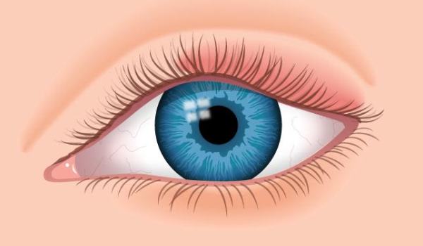 علاج تورم العين: واهم الاسباب والاعراض