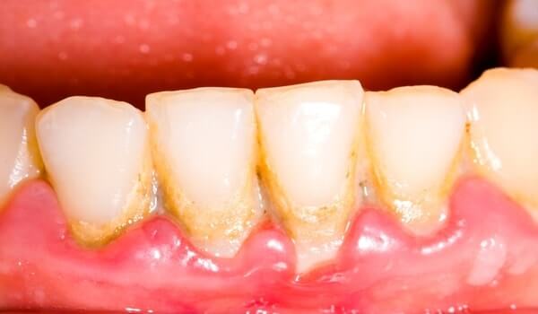 تراكم الجير و البلاك من أسباب التهاب الاسنان واللثة
