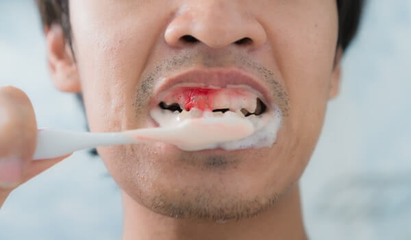 التهاب الاسنان واللثة | دليلك الشامل