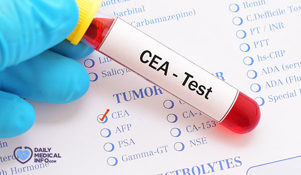 تحليل CEA : هل يساعد في اكتشاف السرطان؟