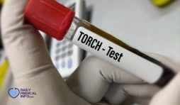 تحليل TORCH