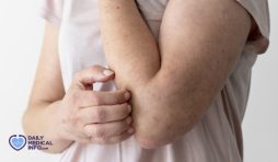 اكزيما اليد: أهم الأعراض والأسباب وكيفية العلاج