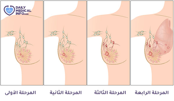 مراحل سرطان الثدي بالصور