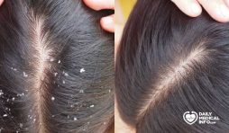 ما هي طرق علاج فطريات الشعر المختلفة؟