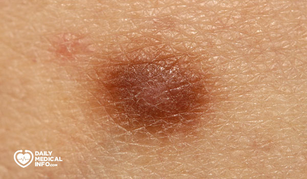 1- الورم الليفي الجلدي Dermatofibroma