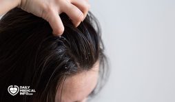 ما هي اكزيما الشعر؟ وما علاماتها وطرق علاجها؟