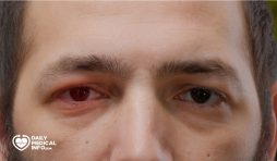 جلطة العين Eye Stroke أسبابها وأعراضها وعلاجها