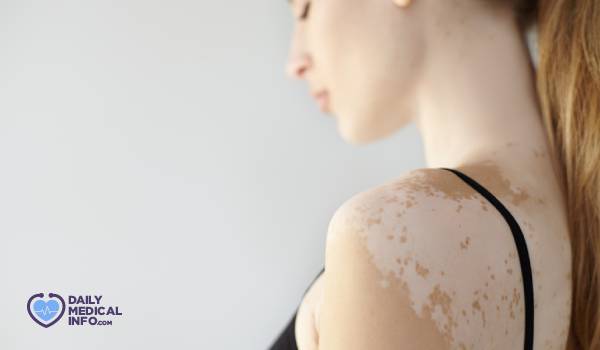 البهاق الشامل Universal Vitiligo