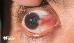 ظفر العين Pterygium أعراضه وأسبابه وعلاجه
