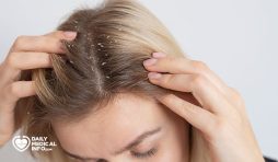 هل يمكن علاج قشرة الشعر نهائياً؟