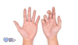 تقوس الأصابع: 5 أسباب محتملة قد تؤدي لحدوثه وطرق علاجه