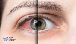 كيفية علاج التهاب العين في المنزل