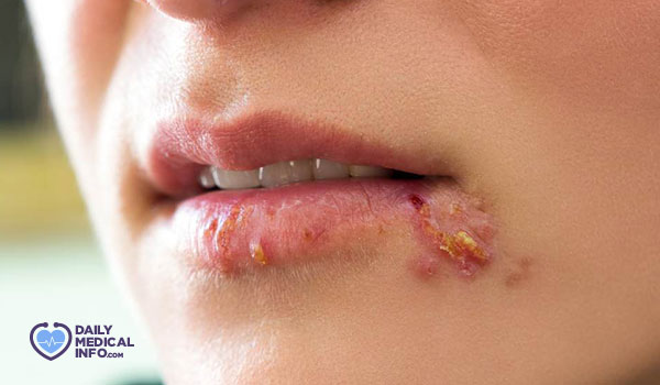 14- الهربس الفموي Oral Herpes