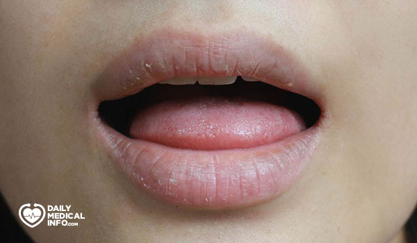 5- جفاف الفم Dry mouth