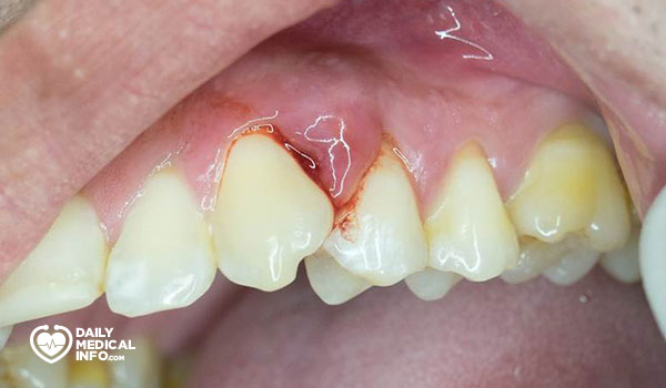 13- خراجات الأسنان Dental Abscesses
