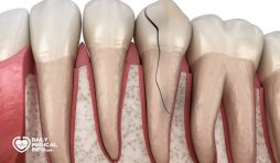 متلازمة تصدع الأسنان Cracked Tooth أسبابها وعلاجها
