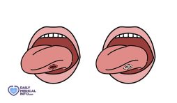 سرطان اللسان Tongue Cancer وأعراضه وعلاجه