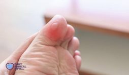 فقاعات القدم Blisters on Feet أسبابها وكيفية علاجها